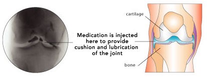 Medication is injected here to provide cushion and lubrication of the joint.
