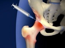 Steroids can be injected directly into a swollen and painful joint to reduce inflammation in hip