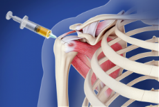 Steroids can be injected directly into a swollen and painful joint to reduce inflammation in shoulder